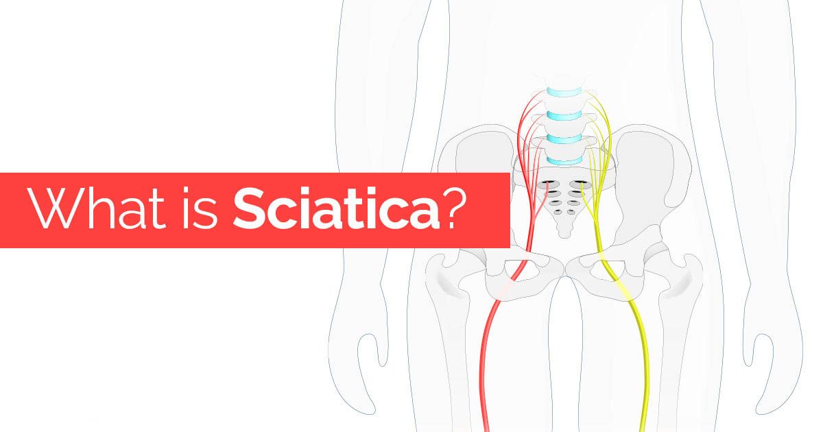 What Is Sciatica(b) - Schluter Chiropractic